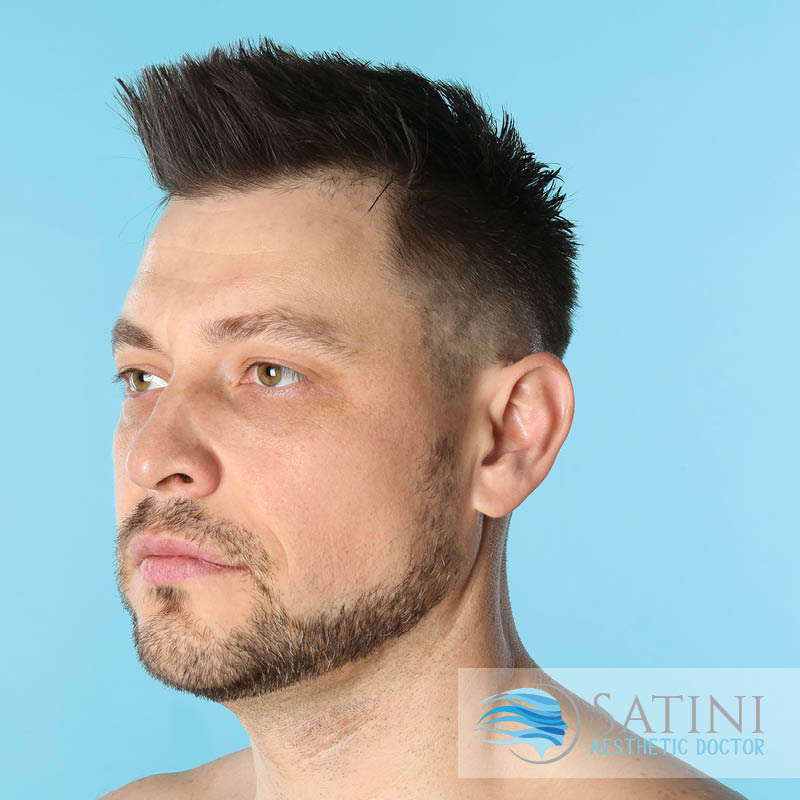 Before and After Brotox-Botox for men-SATINI-Botox clinic near me-Christchurch