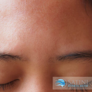 After chemical peel for acne-Botox clinic near me-Christchurch