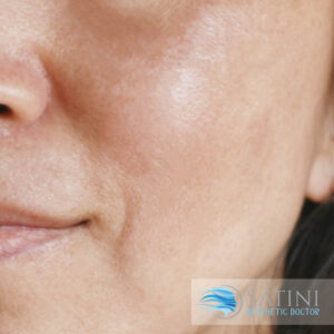 After chemical peel-Botox clinic near me-Christchurch