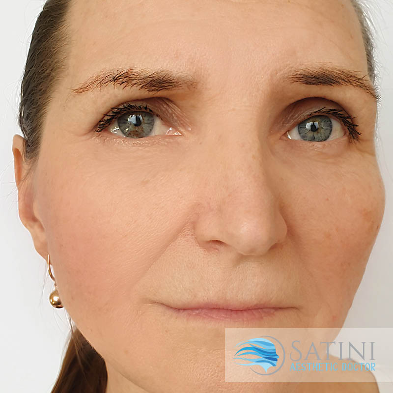 After PRP Facelift-Botox clinic near me-SATINI-Christchurch