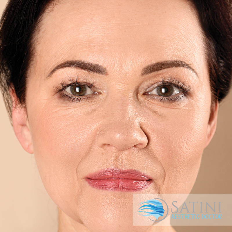 Before and after dermal filler-eight point facelift-Botox clinic near me-Christchurch