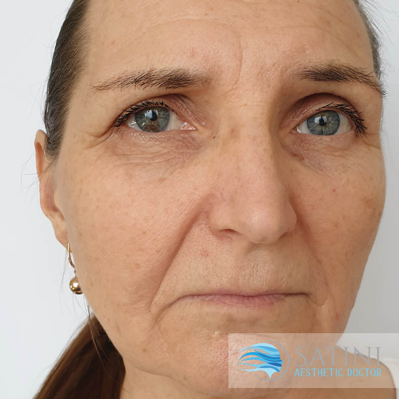 Before PRP Facelift-Botox clinic near me-SATINI-Christchurch