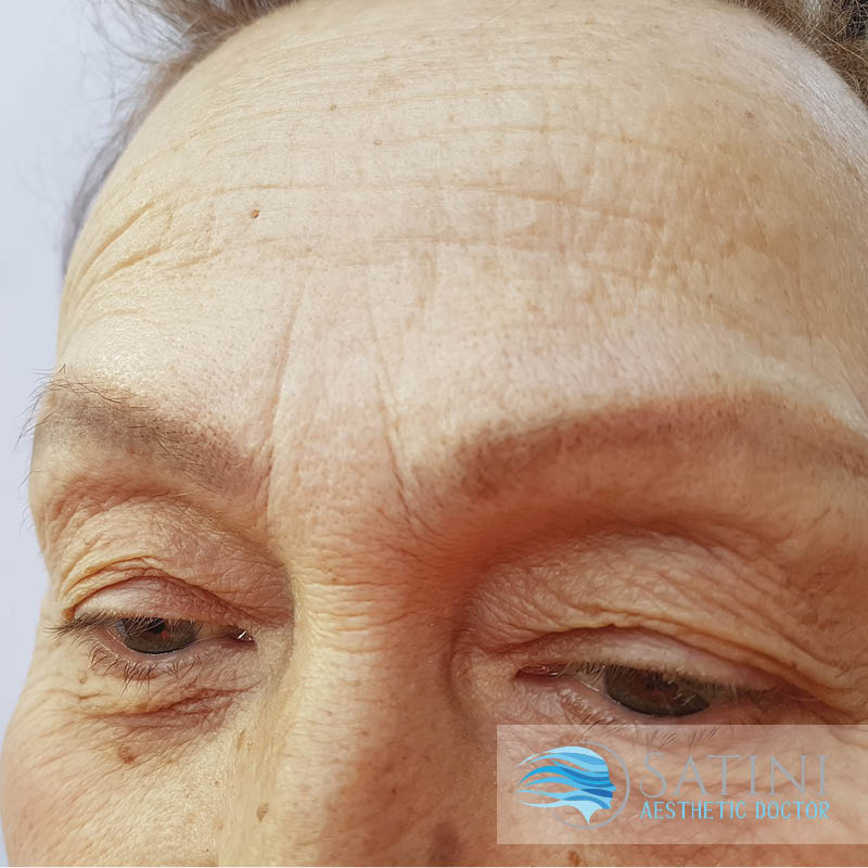 Before and after dermal filler and Botox for the forehead-Botox clinic near me-Christchurch