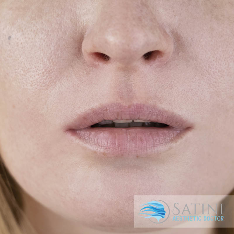 Mouth Corner Lift with Botox-Botox clinic near me-Christchurch-before and after Botox
