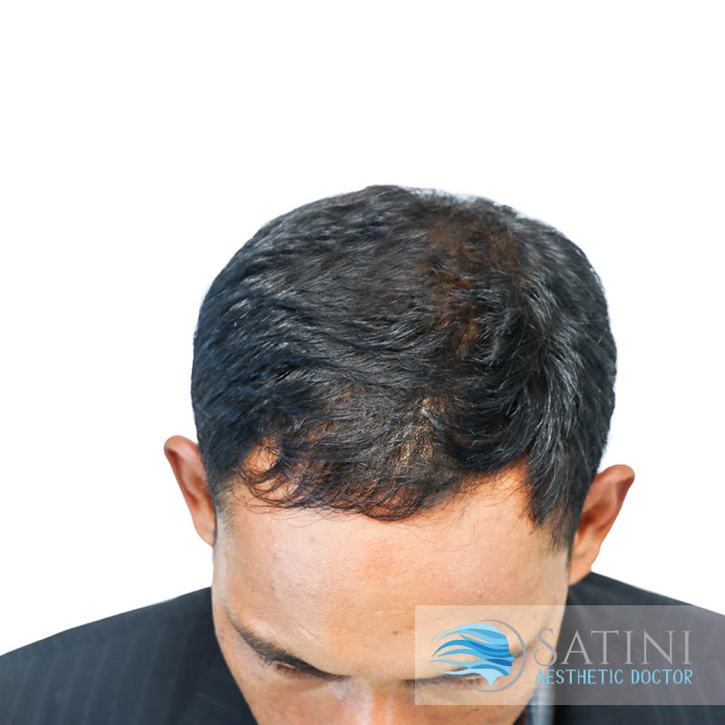 After PRP Platelet Rich Plasma For Male Baldness-Botox Clinic Near Me-Christchurch