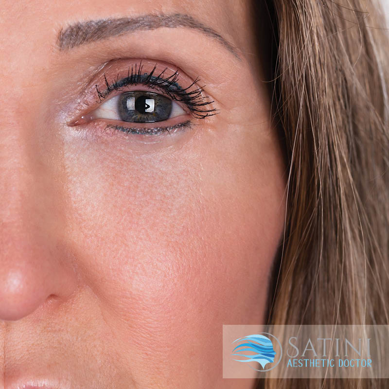 After treatment with botox for Crow's Feet-Botox Clinic Near Me-Christchurch