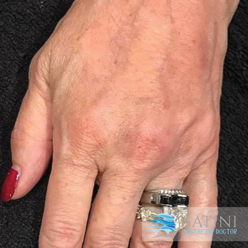 After Dermal Filler For Hands-Botox Clinic Near Me-Christchurch