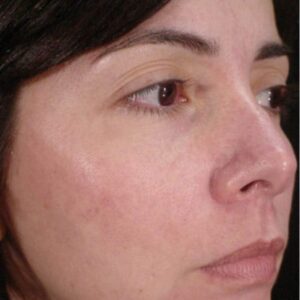 After Cosmelan Peel-Botox Clinic Near Me-Cosmelan Peel near Me