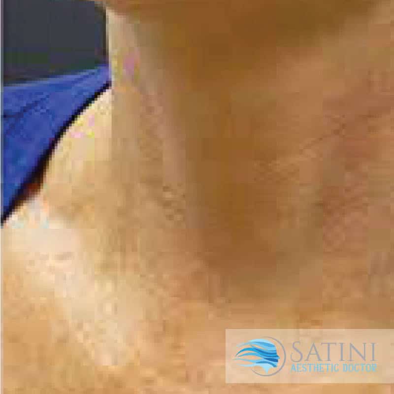 After PRP Platelet Rich Plasma For the Neck-Botox Clinic Near Me-Christchurch